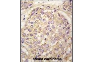 Forlin-fixed and paraffin-embedded hun breast carcino tissue reacted with GEA4 antibody (N-term) (ABIN390108 and ABIN2840620) , which was peroxidase-conjugated to the secondary antibody, followed by DAB staining. (MAGEA4 Antikörper  (N-Term))