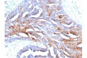 IHC staining of human ovarian carcinoma with TAG-72 antibody (TAG-72 Antikörper)