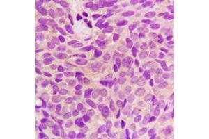 Immunohistochemical analysis of STMN1 staining in human breast cancer formalin fixed paraffin embedded tissue section. (Stathmin 1 Antikörper  (N-Term))
