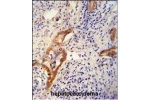 CLPX antibody (C-term) (ABIN654723 and ABIN2844412) immunohistochemistry analysis in formalin fixed and paraffin embedded human hepatocarcinoma followed by peroxidase conjugation of the secondary antibody and DAB staining. (CLPX Antikörper  (C-Term))
