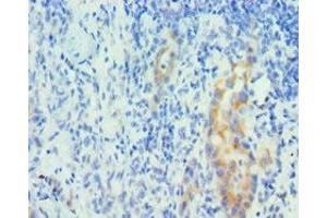 Immunohistochemistry of paraffin-embedded human lung cancer using ABIN7150963 at dilution of 1:100 (PIAS1 Antikörper  (AA 422-651))