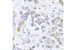 Immunohistochemistry of paraffin-embedded human breast cancer using C antibody (ABIN7266074) at dilution of 1:100 (40x lens). (CA13 Antikörper  (AA 1-220))