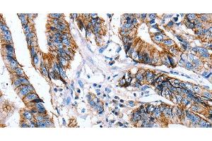Immunohistochemistry of paraffin-embedded Human colon cancer using Claudin 7 Polyclonal Antibody at dilution of 1:50 (Claudin 7 Antikörper)