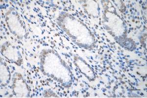Immunohistochemistry was performed on paraffin-embedded human gastric carcinoma using RALY antibody (ABIN7800263), 1:200).