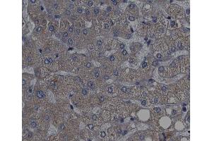 ABIN6267439 at 1/200 staining human liver cancer tissue sections by IHC-P. (RPS6KB1 Antikörper  (pThr389, pThr412))