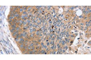 Immunohistochemistry of paraffin-embedded Human esophagus cancer using REG3A Polyclonal Antibody at dilution of 1:40 (REG3A Antikörper)