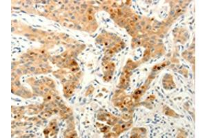 The image on the left is immunohistochemistry of paraffin-embedded Human lung cancer tissue using ABIN7190632(FAT4 Antibody) at dilution 1/20, on the right is treated with synthetic peptide. (FAT4 Antikörper)