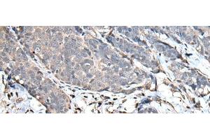 Immunohistochemistry of paraffin-embedded Human thyroid cancer tissue using UPK3A Polyclonal Antibody at dilution of 1:30(x200) (Uroplakin 3A Antikörper)