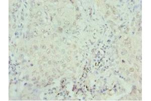 Immunohistochemistry of paraffin-embedded human lung cancer using ABIN7168762 at dilution of 1:100 (SEPHS1 Antikörper  (AA 1-392))