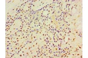 Immunohistochemistry of paraffin-embedded human breast cancer using ABIN7169355 at dilution of 1:100 (SRRT Antikörper  (AA 627-876))