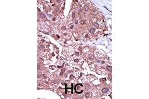 Formalin-fixed and paraffin-embedded human cancer tissue reacted with the primary antibody, which was peroxidase-conjugated to the secondary antibody, followed by DAB staining. (ACVRL1 Antikörper  (C-Term))