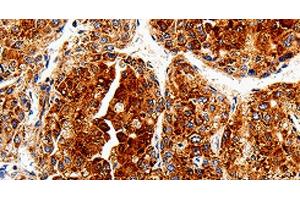 Immunohistochemistry of paraffin-embedded Human liver cancer tissue using COX19 Polyclonal Antibody at dilution 1:50 (COX19 Antikörper)