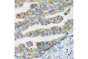 Immunohistochemistry of paraffin-embedded human gastric cancer using TXN2 antibody (ABIN5974110) at dilution of 1/100 (40x lens).