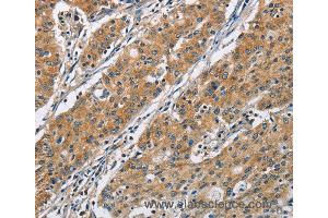 Immunohistochemistry of Human gastric cancer using COPB1 Polyclonal Antibody at dilution of 1:50 (COPB1 Antikörper)