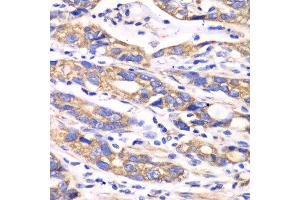 Immunohistochemistry of paraffin-embedded human colon carcinoma using TXN2 antibody at dilution of 1:100 (x40 lens). (TXN2 Antikörper)
