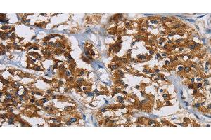 Immunohistochemistry of paraffin-embedded Human thyroid cancer tissue using IGF2R Polyclonal Antibody at dilution 1:40 (IGF2R Antikörper)