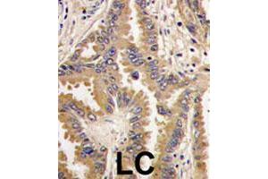 Formalin-fixed and paraffin-embedded human lung carcinoma tissue reacted with BAD polyclonal antibody  , which was peroxidase-conjugated to the secondary antibody, followed by DAB staining. (BAD Antikörper  (Internal Region))