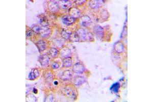 Immunohistochemical analysis of ACAT1 staining in human lung cancer formalin fixed paraffin embedded tissue section. (ACAT1 Antikörper  (Center))