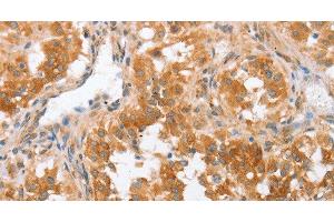 Immunohistochemistry of paraffin-embedded Human thyroid cancer using CRELD2 Polyclonal Antibody at dilution of 1:50 (CRELD2 Antikörper)