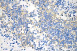 Immunohistochemistry was performed on paraffin-embedded human glioblastoma using neuronal calcium sensor 1 antibody (ABIN7799584), 1:200).