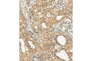 (ABIN392009 and ABIN2837977) staining c-KIT in human breast carcinoma tissue sections by Immunohistochemistry (IHC-P - paraformaldehyde-fixed, paraffin-embedded sections). (KIT Antikörper  (AA 912-941))