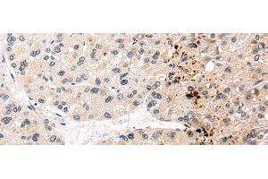 Immunohistochemistry of paraffin-embedded Human liver cancer tissue using AQP11 Polyclonal Antibody at dilution 1:30 (AQP11 Antikörper)