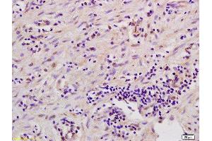 Formalin-fixed and paraffin embedded human gastric carcinoma labeled with Anti-MSK1/RPS6KA5 Polyclonal Antibody, Unconjugated  at 1:200 followed by conjugation to the secondary antibody and DAB staining. (Msk1/2 (AA 49-94) Antikörper)