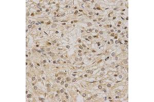 Immunohistochemistry of paraffin-embedded human kidney cancer using LETMD1 antibody at dilution of 1:200 (x40 lens) (LETMD1 Antikörper)