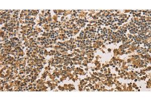 Immunohistochemistry of paraffin-embedded Human tonsil tissue using SETD2 Polyclonal Antibody at dilution 1:40 (SETD2 Antikörper)