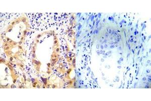 Immunohistochemical analysis of paraffin-embedded human lung carcinoma tissue using P53 (phospho-Ser37) antibody (E012031). (p53 Antikörper  (pSer37))