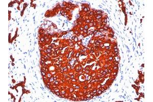 Formalin-fixed, paraffin-embedded human Breast Carcinoma stained with Cytokeratin, pan Monoclonal Antibody cocktail (KRTL/1077 + KRTH/1076). (KRT77, KRT76 Antikörper)