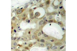 Immunohistochemistry of paraffin-embedded human breast carcinoma using Phospho-AR-S650 antibody (ABIN2987884). (Androgen Receptor Antikörper  (pSer650))
