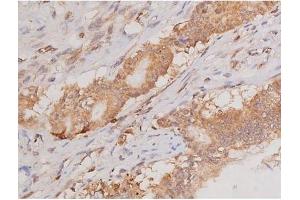 ABIN6269133 at 1/200 staining Human colon cancer tissue sections by IHC-P. (KIT Antikörper  (Internal Region))