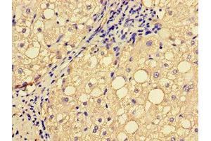 Immunohistochemistry of paraffin-embedded human liver cancer using ABIN7151827 at dilution of 1:100 (EPHA1 Antikörper  (AA 296-414))