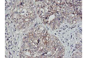 Immunohistochemical staining of paraffin-embedded Adenocarcinoma of Human ovary tissue using anti-PDSS2 mouse monoclonal antibody.