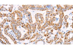 Immunohistochemistry of paraffin-embedded Human thyroid cancer using ATPIF1 Polyclonal Antibody at dilution of 1:50 (ATPase Inhibitory Factor 1 Antikörper)