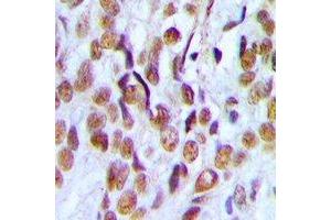 Immunohistochemical analysis of PHF19 staining in human ovarian cancer formalin fixed paraffin embedded tissue section. (PHF19 Antikörper)