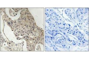 Immunohistochemical analysis of paraffin-embedded human breast carcinoma tissue using Gab2 (Phospho-Ser623) antibody (left)or the same antibody preincubated with blocking peptide (right). (GAB2 Antikörper  (pSer623))