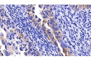 Detection of MMP7 in Human Endometrial cancer Tissue using Polyclonal Antibody to Matrix Metalloproteinase 7 (MMP7) (MMP7 Antikörper  (AA 1-267))