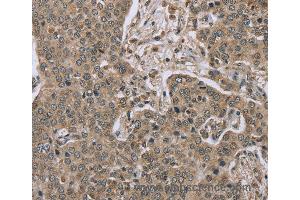 Immunohistochemistry of Human lung cancer using IL15RA Polyclonal Antibody at dilution of 1:45 (IL15RA Antikörper)