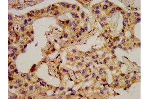 IHC image of ABIN7161261 diluted at 1:400 and staining in paraffin-embedded human liver cancer performed on a Leica BondTM system. (PCSK2 Antikörper  (AA 267-391))