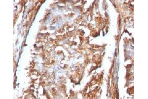 Formalin-fixed, paraffin-embedded human renal carcinoma stained with Beta-2-Microglobulin antibody. (beta-2 Microglobulin Antikörper)
