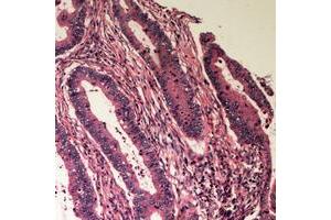 Immunohistochemical analysis of B4GALT2 staining in human colon cancer formalin fixed paraffin embedded tissue section.