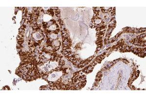 ABIN6267216 at 1/100 staining Human thyroid cancer tissue by IHC-P. (WIPI2 Antikörper  (C-Term))