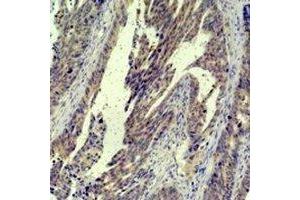Immunohistochemical analysis of c-Jun staining in human breast cancer formalin fixed paraffin embedded tissue section. (C-JUN Antikörper)