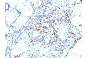 Formalin-fixed, paraffin-embedded human angiosarcoma stained with SMMHC antibody (MYH11/923 + SMMS-1). (MYH11 Antikörper)