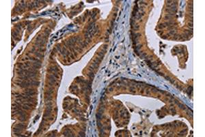 The image on the left is immunohistochemistry of paraffin-embedded Human gastric cancer tissue using ABIN7191352(MAGEB3 Antibody) at dilution 1/20, on the right is treated with synthetic peptide. (MAGEB3 Antikörper)