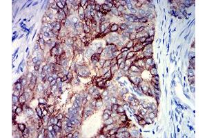 Immunohistochemical analysis of paraffin-embedded cervical cancer tissues using TNFRSF18 mouse mAb with DAB staining.