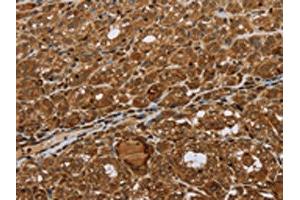 The image on the left is immunohistochemistry of paraffin-embedded Human thyroid cancer tissue using ABIN7192693(STMN2/STMN3/STMN4 Antibody) at dilution 1/45, on the right is treated with synthetic peptide. (STMN2/STMN3/STMN4 Antikörper)