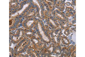 Immunohistochemistry of Human colon cancer using TLR8 Polyclonal Antibody at dilution of 1:40 (TLR8 Antikörper)